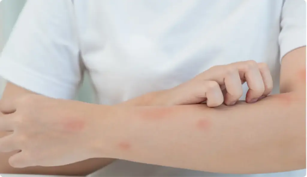Person scratching forearm with red rash spots, suggesting itching and hives that may occur during an allergic reaction after meth use.